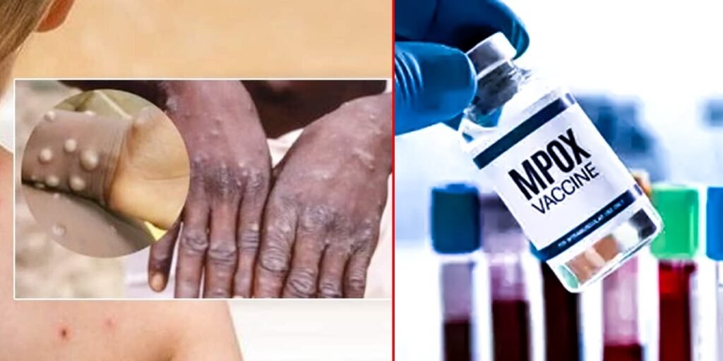 KP reports first domestic case of Monkeypox