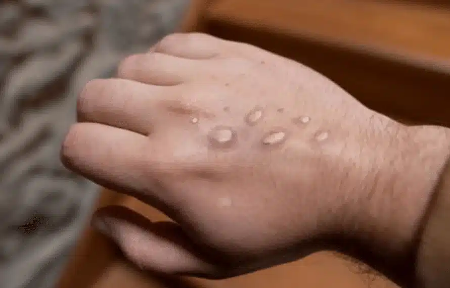 KP reports two more Mpox cases, total surges to five this year