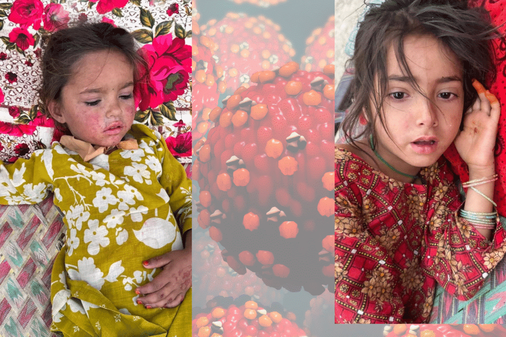 Measles outbreak in North Waziristan’s Spin Wam tehsil leaves children at risk due to no vaccines