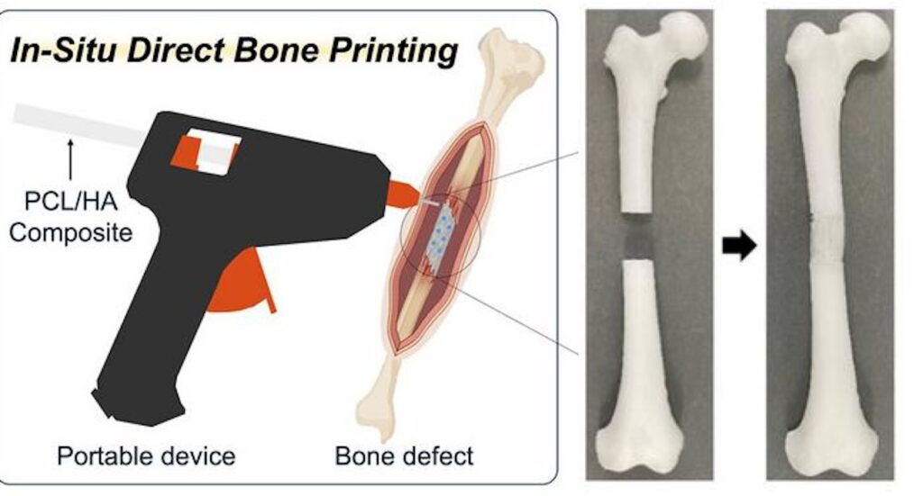 Scientists develop 3D-Printing 'Glue Gun' for bone grafts